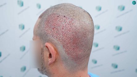 Injerto Capilar Técnica FUE Grafts 2669 (6813 Pelos) 23 19 TRASPLANTE DE PELO