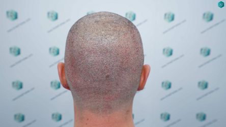 Injerto Capilar Técnica FUE Grafts 2669 (6813 Pelos) 24 22 TRASPLANTE DE PELO