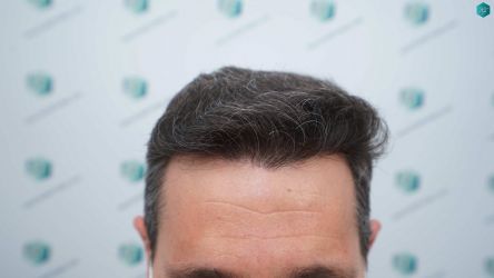 Injerto Capilar Técnica FUE Grafts 2669 (6813 Pelos) 25 25 RESULTADOS 12 MESES