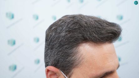 Injerto Capilar Técnica FUE Grafts 2669 (6813 Pelos) 29 26 RESULTADOS 12 MESES