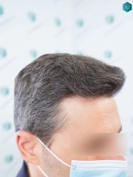 Injerto Capilar Técnica FUE Grafts 2669 (6813 Pelos) 28 26A RESULTADOS 12 MESES
