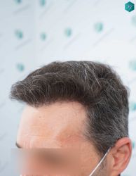 Injerto Capilar Técnica FUE Grafts 2669 (6813 Pelos) 30 27A RESULTADOS 12 MESES