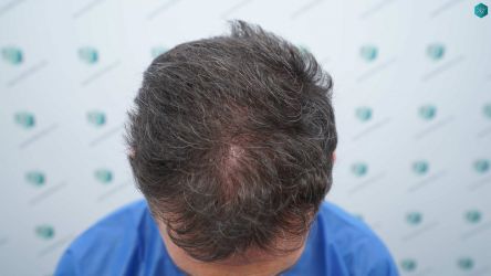 Injerto Capilar Técnica FUE Grafts 2669 (6813 Pelos) 3 2A ANTES DEL TRASPLANTE CAPILAR