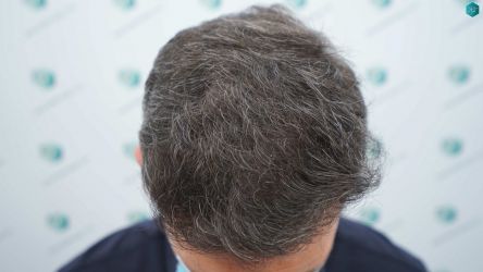 Injerto Capilar Técnica FUE Grafts 2669 (6813 Pelos) 27 31 RESULTADOS 12 MESES