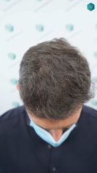 Injerto Capilar Técnica FUE Grafts 2669 (6813 Pelos) 26 32 RESULTADOS A LOS 12 MESES