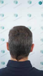 Injerto Capilar Técnica FUE Grafts 2669 (6813 Pelos) 34 33 RESULTADOS A LOS 12 MESES