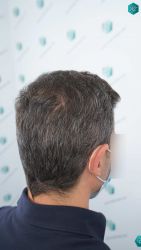 Injerto Capilar Técnica FUE Grafts 2669 (6813 Pelos) 31 34 RESULTADOS A LOS 12 MESES