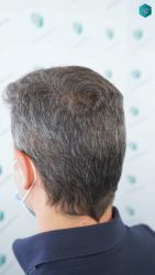 Injerto Capilar Técnica FUE Grafts 2669 (6813 Pelos) 32 35 RESULTADOS A LOS 12 MESES
