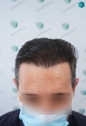 Injerto Capilar Técnica FUE Grafts 2669 (6813 Pelos) 36 37 RESULTADOS A LOS 12 MESES