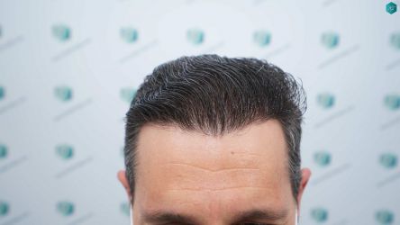 Injerto Capilar Técnica FUE Grafts 2669 (6813 Pelos) 37 38A RESULTADOS A LOS 12 MESES