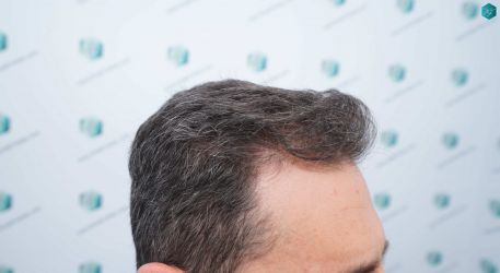 Injerto Capilar Técnica FUE Grafts 2669 (6813 Pelos) 4 4 ANTES DEL TRASPLANTE CAPILAR