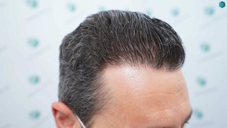 Injerto Capilar Técnica FUE Grafts 2669 (6813 Pelos) 38 40 RESULTADOS A LOS 12 MESES