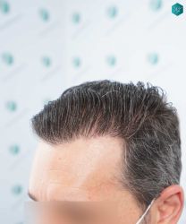 Injerto Capilar Técnica FUE Grafts 2669 (6813 Pelos) 40 41 RESULTADOS A LOS 12 MESES