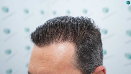 Injerto Capilar Técnica FUE Grafts 2669 (6813 Pelos) 39 42 RESULTADOS A LOS 12 MESES