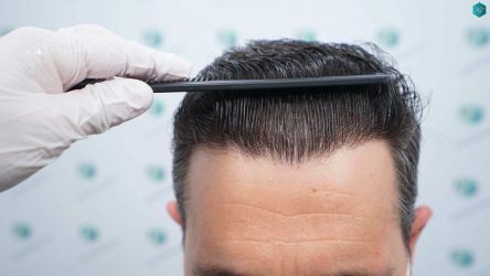 Injerto Capilar Técnica FUE Grafts 2669 (6813 Pelos) 44 43 RESULTADOS A LOS 12 MESES