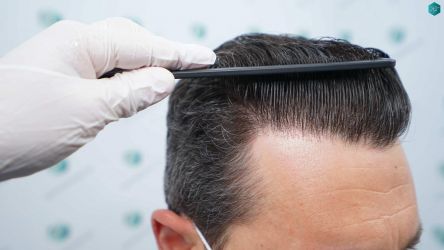 Injerto Capilar Técnica FUE Grafts 2669 (6813 Pelos) 42 44 RESULTADOS A LOS 12 MESES