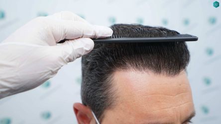 Injerto Capilar Técnica FUE Grafts 2669 (6813 Pelos) 41 45 RESULTADOS A LOS 12 MESES