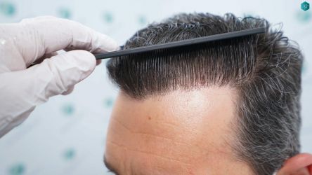 Injerto Capilar Técnica FUE Grafts 2669 (6813 Pelos) 43 46 RESULTADOS A LOS 12 MESES