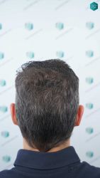 Injerto Capilar Técnica FUE Grafts 2669 (6813 Pelos) 33 47 RESULTADOS A LOS 12 MESES