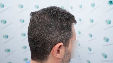 Injerto Capilar Técnica FUE Grafts 2669 (6813 Pelos) 6 4A ANTES DEL TRASPLANTE CAPILAR