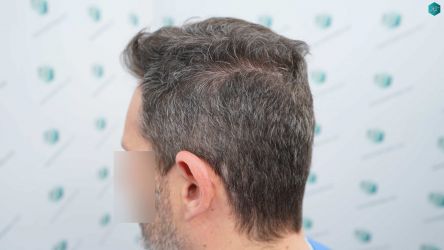 Injerto Capilar Técnica FUE Grafts 2669 (6813 Pelos) 7 4AB ANTES DEL TRASPLANTE CAPILAR