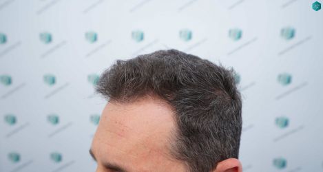 Injerto Capilar Técnica FUE Grafts 2669 (6813 Pelos) 5 5 ANTES DEL TRASPLANTE CAPILAR