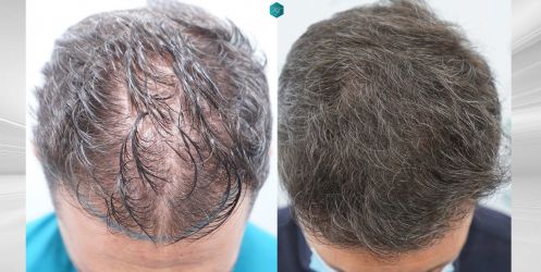 Injerto Capilar Técnica FUE Grafts 2669 (6813 Pelos) 51 50 COMPARATIVAS 1