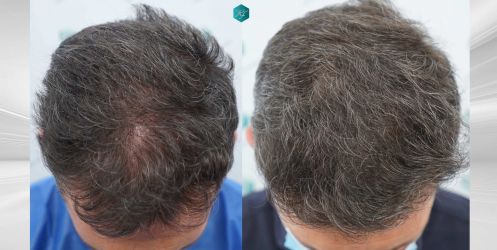 Injerto Capilar Técnica FUE Grafts 2669 (6813 Pelos) 50 50 COMPARATIVAS
