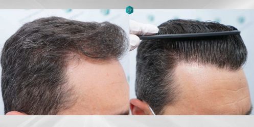 Injerto Capilar Técnica FUE Grafts 2669 (6813 Pelos) 46 51 COMPARATIVAS