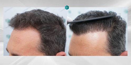 Injerto Capilar Técnica FUE Grafts 2669 (6813 Pelos) 47 52 COMPARATIVAS