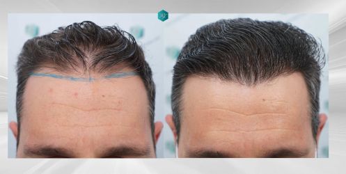 Injerto Capilar Técnica FUE Grafts 2669 (6813 Pelos) 48 53 COMPARATIVAS