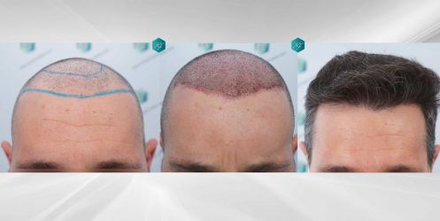 Injerto Capilar Técnica FUE Grafts 2669 (6813 Pelos) 49 54 COMPARATIVAS