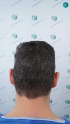 Injerto Capilar Técnica FUE Grafts 2669 (6813 Pelos) 45 6 ANTES DEL TRASPLANTE CAPILAR