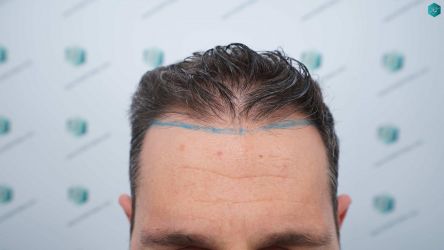 Injerto Capilar Técnica FUE Grafts 2669 (6813 Pelos) 8 7 DISENO LINEA TRASPLANTE DE PELO