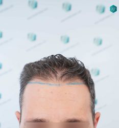 DISEÑO LINEA TRASPLANTE DE PELO 7A DISENO LINEA TRASPLANTE DE PELO