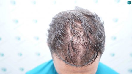 Injerto Capilar Técnica FUE Grafts 2669 (6813 Pelos) 10 8 DISENO LINEA TRASPLANTE DE PELO