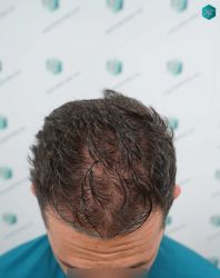 Injerto Capilar Técnica FUE Grafts 2669 (6813 Pelos) 9 9 DISENO LINEA TRASPLANTE DE PELO