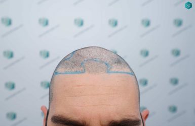 Injerto Capilar Técnica FUE Grafts 3161 (8204 Pelos) 8 10 ANTES DEL TRASPLANTE DE PELO