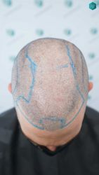 Injerto Capilar Técnica FUE Grafts 3161 (8204 Pelos) 9 11 ANTES DEL TRASPLANTE DE PELO