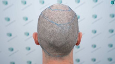 Injerto Capilar Técnica FUE Grafts 3161 (8204 Pelos) 12 12 ANTES DEL TRASPLANTE DE PELO