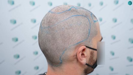 Injerto Capilar Técnica FUE Grafts 3161 (8204 Pelos) 10 12A ANTES DEL TRASPLANTE DE PELO