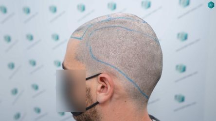 Injerto Capilar Técnica FUE Grafts 3161 (8204 Pelos) 11 12B ANTES DEL TRASPLANTE DE PELO