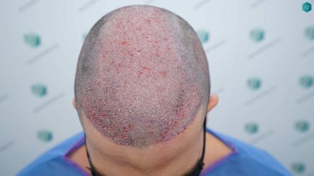 Injerto Capilar Técnica FUE Grafts 3161 (8204 Pelos) 14 15 TRASPLANTE CAPILAR