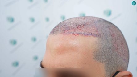 Injerto Capilar Técnica FUE Grafts 3161 (8204 Pelos) 17 17 TRASPLANTE CAPILAR