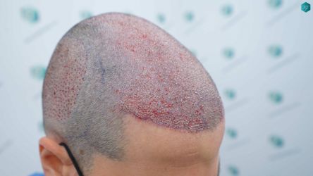 Injerto Capilar Técnica FUE Grafts 3161 (8204 Pelos) 15 18 TRASPLANTE CAPILAR