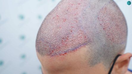 Injerto Capilar Técnica FUE Grafts 3161 (8204 Pelos) 20 19 TRASPLANTE CAPILAR