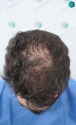Injerto Capilar Técnica FUE Grafts 3161 (8204 Pelos) 6 2 ANTES DEL TRASPLANTE DE PELO