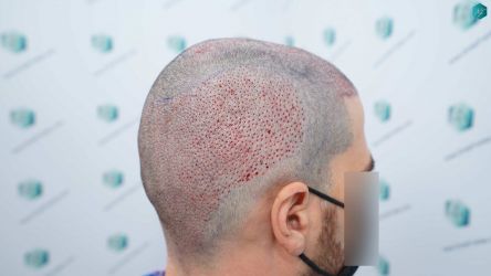 Injerto Capilar Técnica FUE Grafts 3161 (8204 Pelos) 18 20 TRASPLANTE CAPILAR