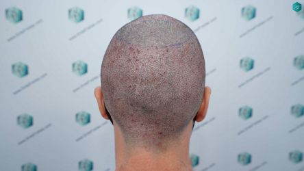 Injerto Capilar Técnica FUE Grafts 3161 (8204 Pelos) 22 22 TRASPLANTE CAPILAR