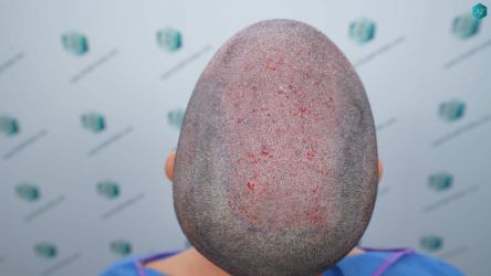 Injerto Capilar Técnica FUE Grafts 3161 (8204 Pelos) 21 23 TRASPLANTE CAPILAR